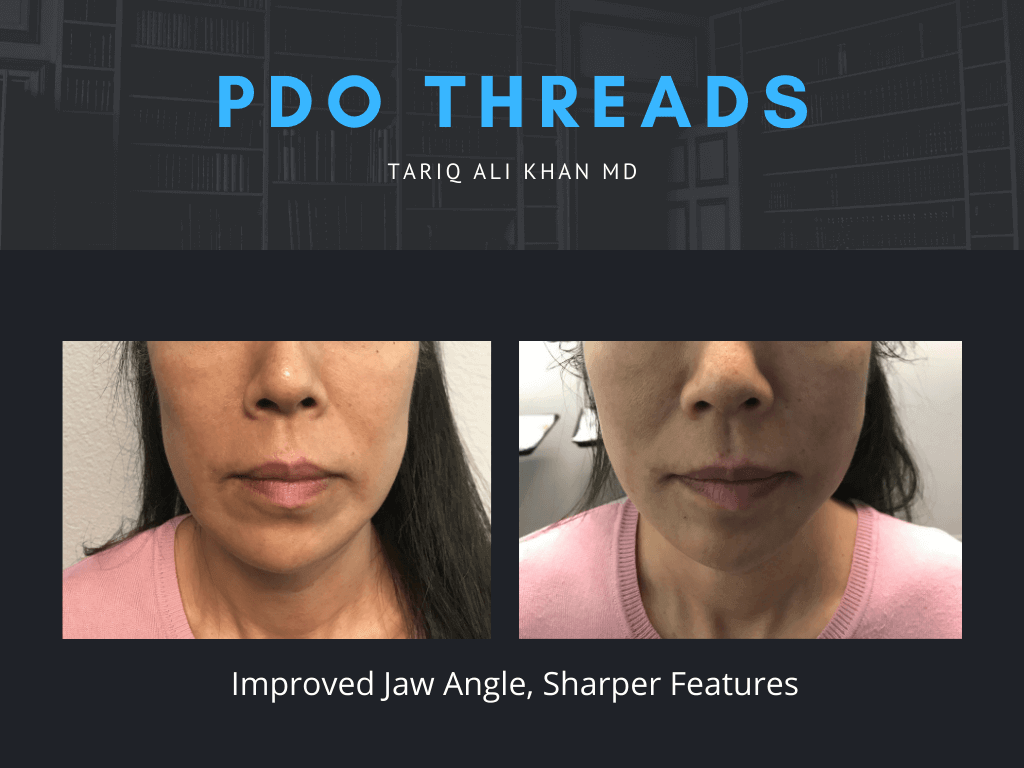 Gentle Care Laser Tustin Before and After picture - PDO Threads